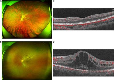 Composition and diversity of gut microbiota in diabetic retinopathy